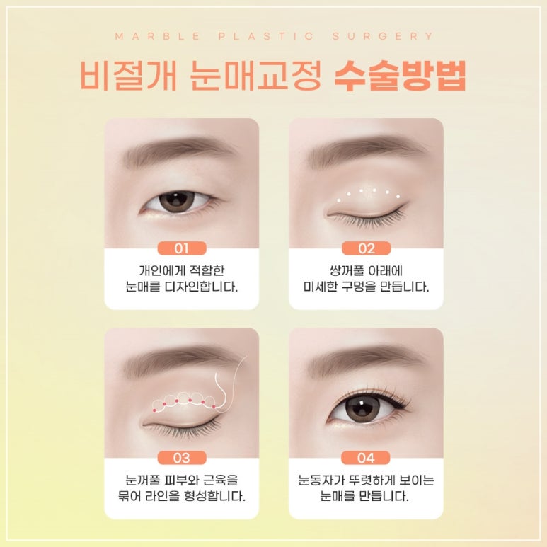 눈매교정 수술, 꼭 필요한가? 관련 이미지 8