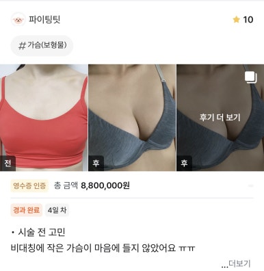[강남성형외과 가슴수술 후기] 가슴 콤플렉스 탈출 성공! 서일범 원장님의 비대칭 맞춤 설계 덕분이에요! 관련 이미지 1