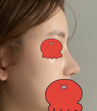 [강남성형외과 매부리코성형 후기] 부작용만 찾다가,, 금손 원장님 만나 코 정착했어요! 관련 이미지 5
