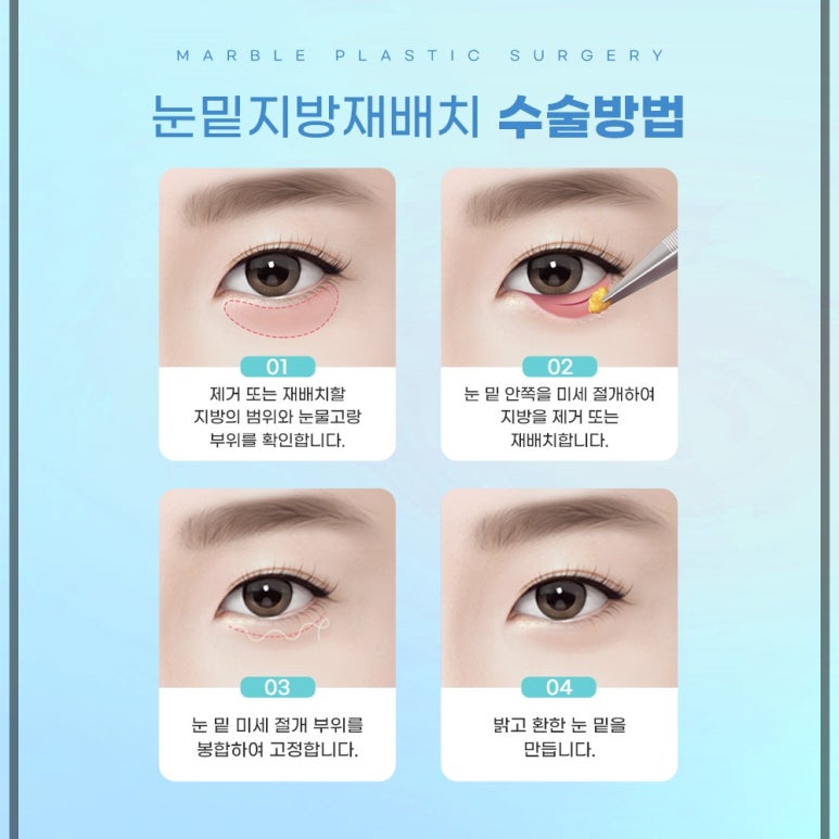 눈밑지방재배치와 다크서클 완화, 두 마리 토끼를 잡다 관련 이미지 4