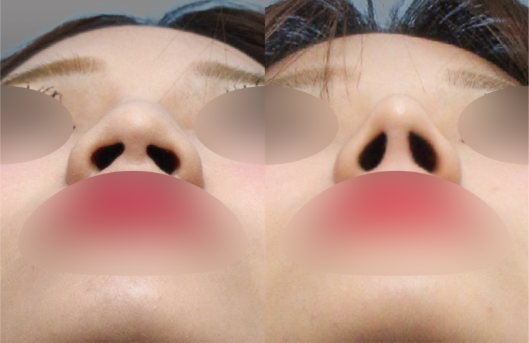 [First Rhinoplasty] Month 2 of Hump Nose Correction: The Standard for Implant-Free Hump Nose Correction image 6