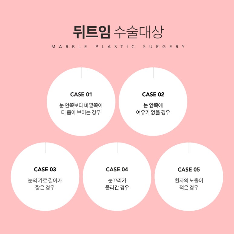 뒷트임후기는 물론 수술방법까지 달리하여 마블성형외과의원 관련 이미지 3