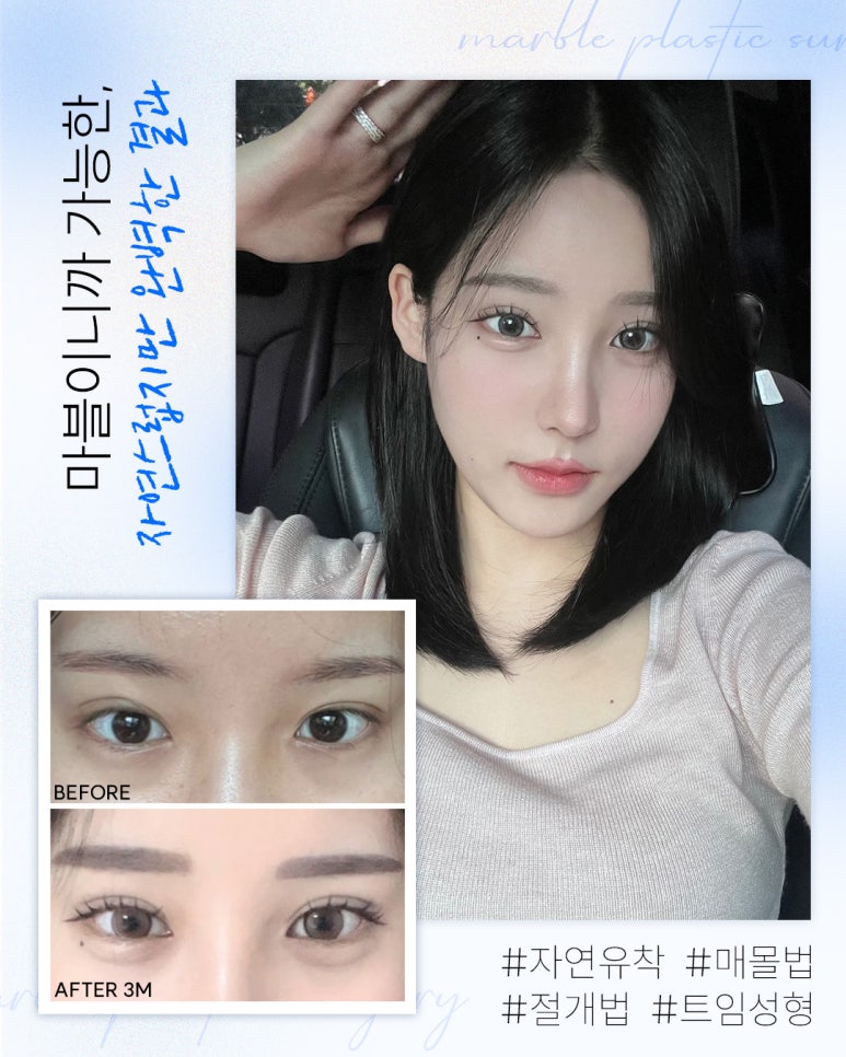 수험생눈성형 알아 볼 때 고려해야 할 것은? 관련 이미지 1