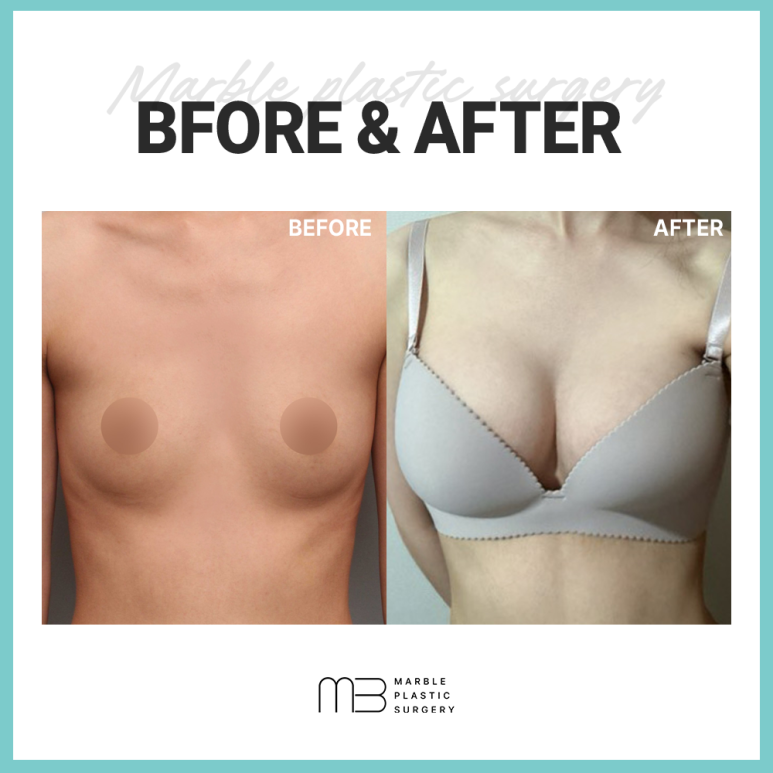 가슴 보형물, 모양 촉감 차이 왜 이렇게 다를까요? 관련 이미지 1
