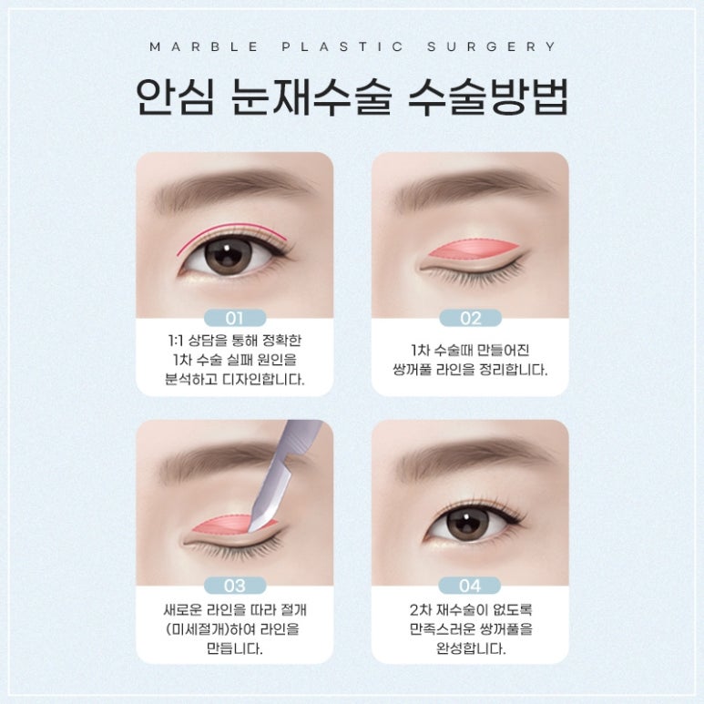 눈재수술비용 및 고려할 점 관련 이미지 3