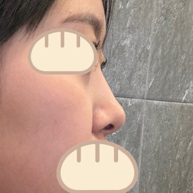 [강남성형외과 복코성형 후기] 보정하기 바빴던 펑퍼짐한 복코.. 얼굴 밸런스에 맞게 바꿔주셨어요! 관련 이미지 3