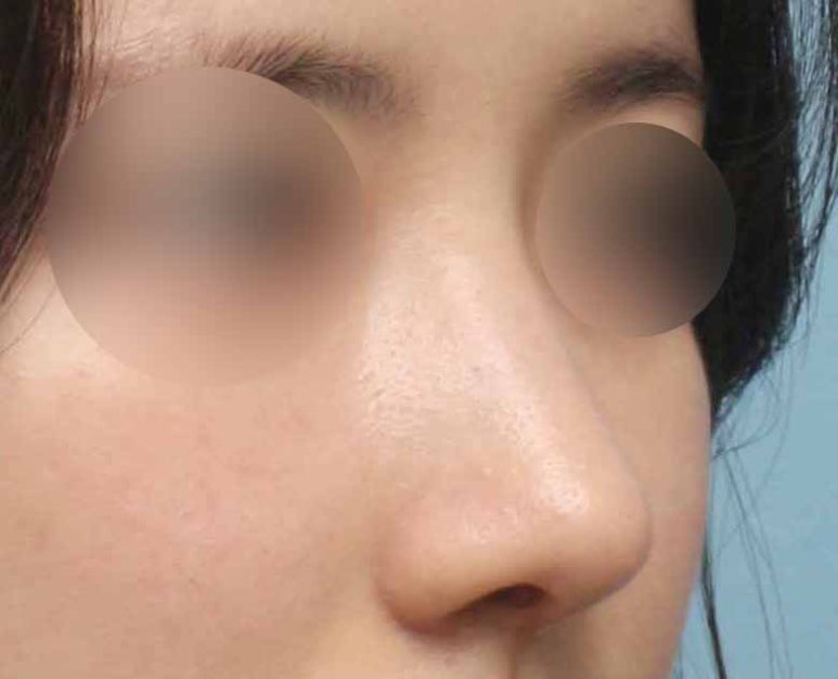 매부리코수술 전후 공개, 과하지 않게 교정한 리얼 경험 관련 이미지 5