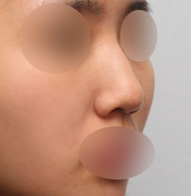 보형물 없이 하는 코수술, 무보형물 코수술이 가능한 경우는? 관련 이미지 3