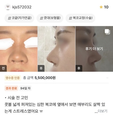 [Gangnam Station Plastic Surgery Clinic Rhinoplasty Review] My concerns about widely flared nostrils and a nasal hump… Everything improved after meeting Dr. Junhyung Kim! image 1