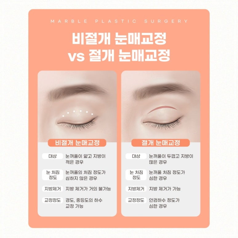 눈매교정 수술, 꼭 필요한가? 관련 이미지 7