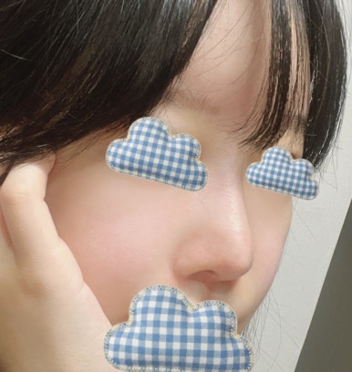 [강남역 성형외과 코재수술 후기] 얇은 코 고민 탈출! 원장님 디테일 덕분에 자려한 코 완성했어요ㅎㅎ 관련 이미지 3