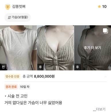 [Gangnam Plastic Surgery Breast Surgery Review] Worried About Uneven Breasts.. After Meeting Director Seo Il-beom, with 25 Years of Experience, I Found the Perfect Volume! image 1