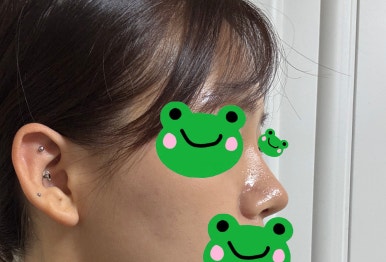 [Gangnam Plastic Surgery Rhinoplasty Review] My Short Nose Looked Upturned from the Front… Now It Has the Perfect Line with Postoperative Care Too! image 5