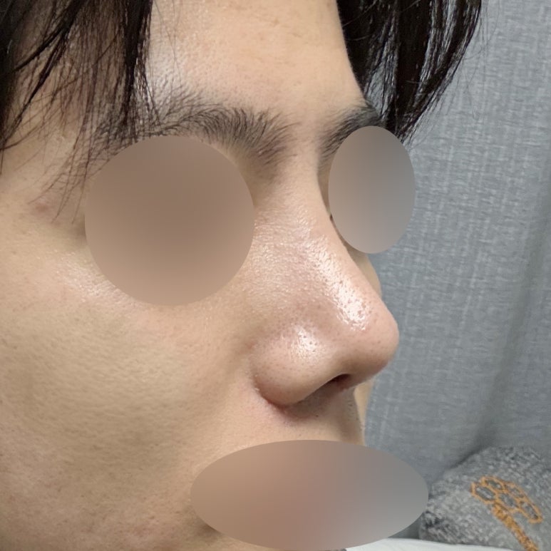 Improving Your Impression Before and After Male Rhinoplasty image 5