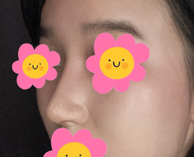 [Marble Plastic Surgery Nose Surgery Review] I Kept Worrying About My Hump Nose... I Should Have Had Surgery Sooner image 5