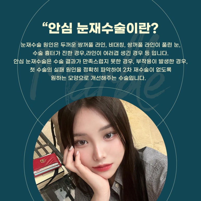 쌍꺼풀재수술 새로운 시작을 위한 가이드 관련 이미지 2