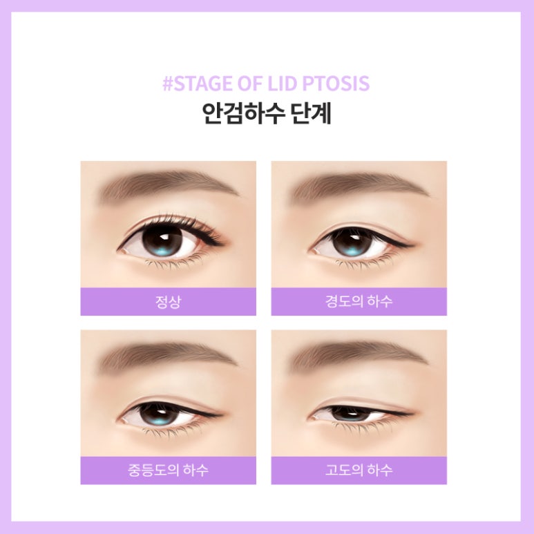 안검하수 처진눈 교정으로 또렷한 눈매를! 관련 이미지 6