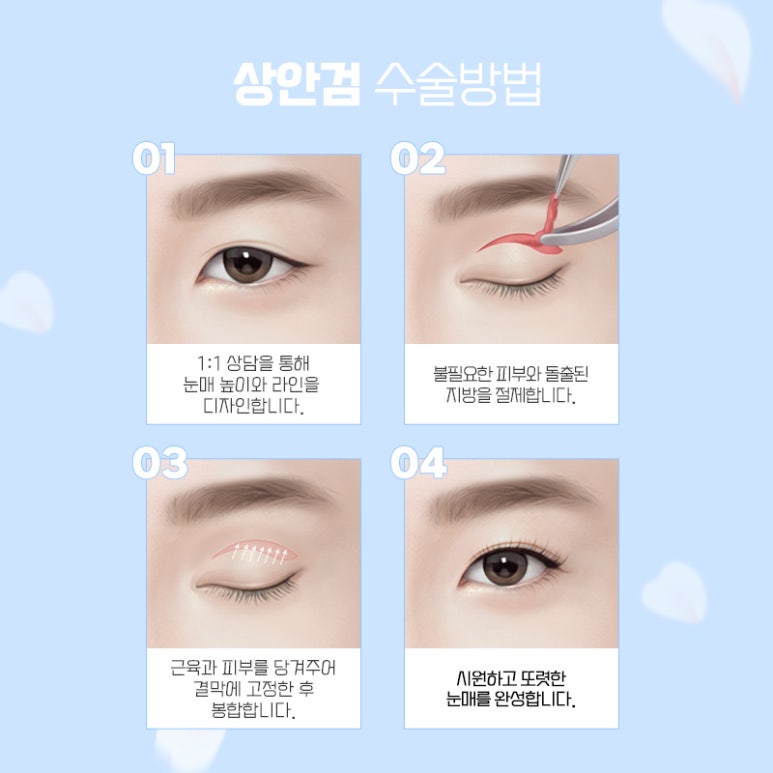 중년눈성형 더 예리하고 젊게 관련 이미지 12