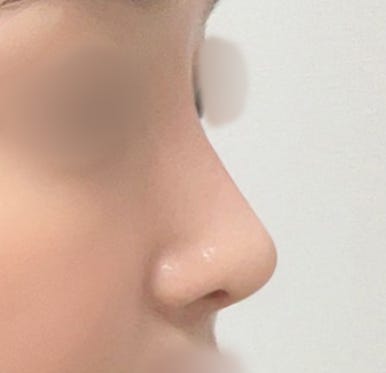 [Gangnam Plastic Surgery Clinic Rhinoplasty Revision Review] No matter how many surgeries I had, my nose still looked flat and wide... Now it has finally settled into a beautiful shape haha image 5