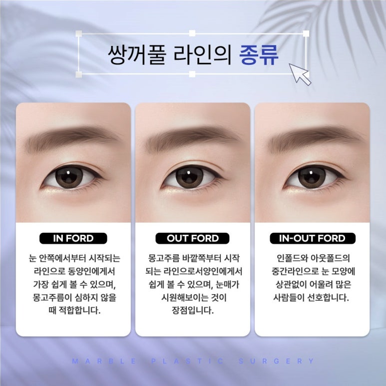 눈성형외과유명한곳, 눈 병원을 찾는다면 관련 이미지 5