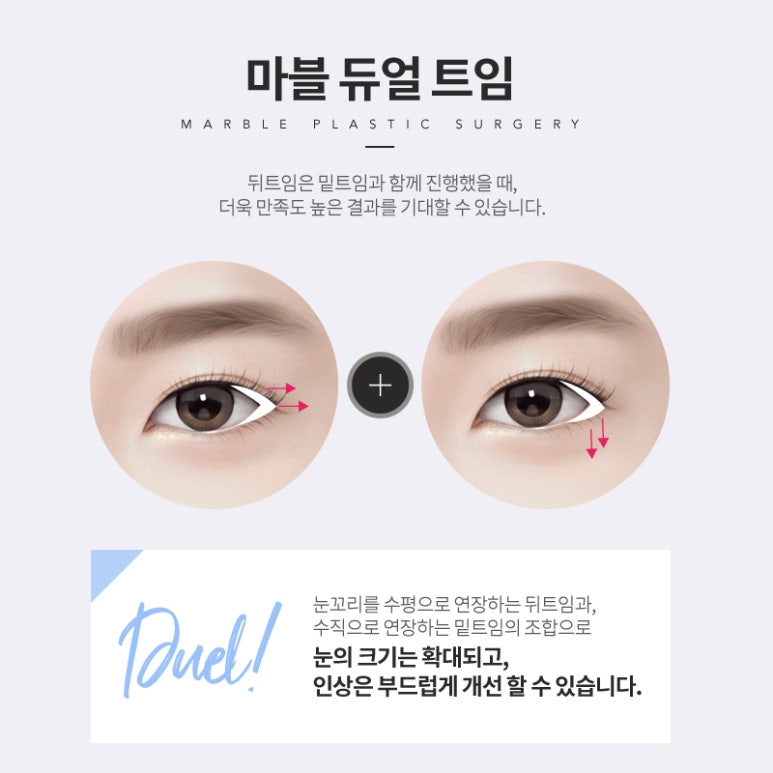 뒷트임밑트임후기 크고 또렷한 눈으로 관련 이미지 5