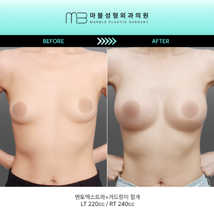 [멘토 가슴수술] 가슴성형 2개월 차: 멘토엑스트라로 완성하는 워너비 실루엣의 정석 관련 이미지 1
