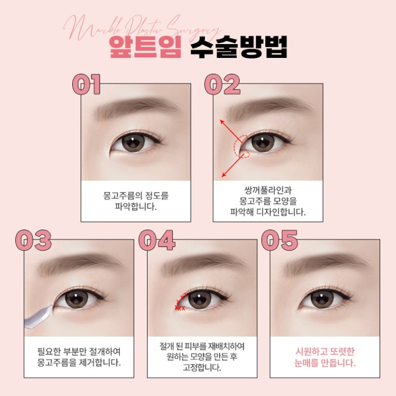 앞트임복원 왜 필요하고 어떻게 진행될까요? 관련 이미지 4