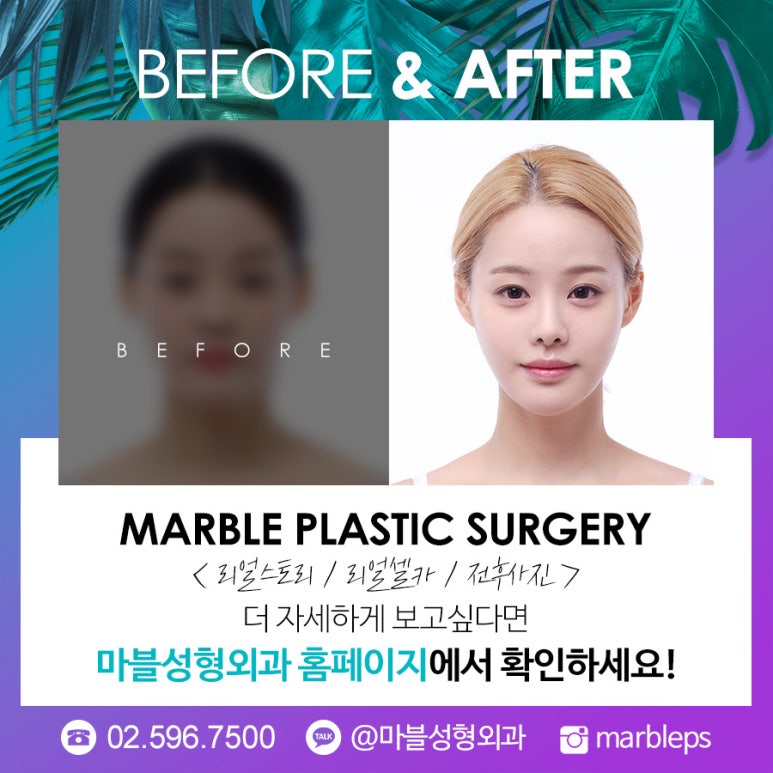 쌍수 눈매교정 앞트임 Q&A!마블성형외과의원 관련 이미지 9
