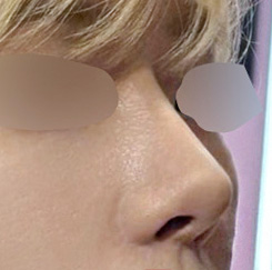[Gangnam Plastic Surgery Clinic Hump Nose Surgery Review] Worried It Might Look Unnatural, I Hesitated About My Hump Nose… Adding Bulbous Nose Correction Helped Me Settle on My Perfect Nose Line! image 7