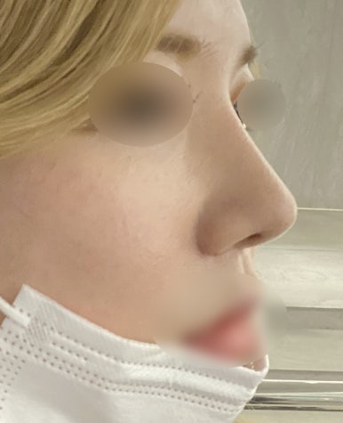 [Gangnam Plastic Surgery Revision Rhinoplasty Review] My bulbous nose showed no improvement at all… I found the nose shape I’ve always wanted after meeting Dr. Junhyung Kim haha image 7