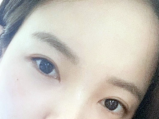 눈밑트임후기 부드러운 인상으로 변화 관련 이미지 2