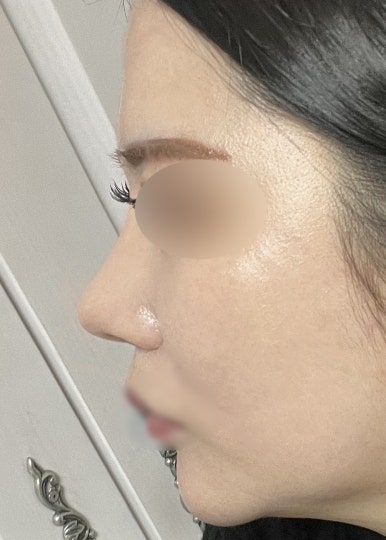 [Gangnam Plastic Surgery Revision Rhinoplasty Review] My bulbous nose showed no improvement at all… I found the nose shape I’ve always wanted after meeting Dr. Junhyung Kim haha image 6