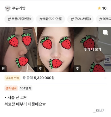 [강남성형외과 매부리코수술 후기] 인상 망치는 매부리와 복코 고민.. 직반버선 라인으로 완성했어요! 관련 이미지 1