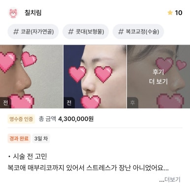 [매부리코수술 후기] 뭉툭한 코끝에 매부리가 고민이었는데..조금이라도 빨리할걸 아쉽네요ㅠㅠ 관련 이미지 1