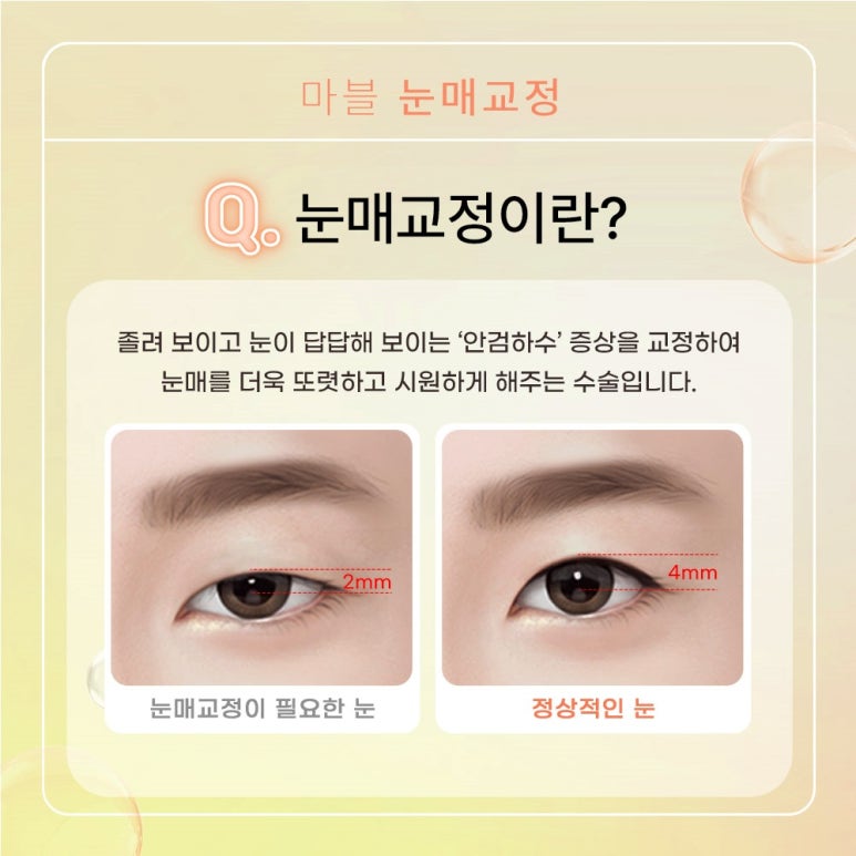 남자눈매교정가격, 잘 알아보고 결정 관련 이미지 2