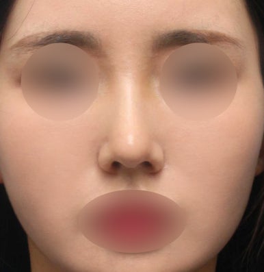보형물 없이 하는 코수술, 무보형물 코수술이 가능한 경우는? 관련 이미지 2