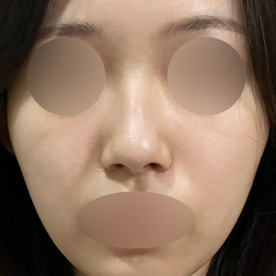 Hump Nose Surgery Is Not Simply a Procedure to Shave It Down. image 3
