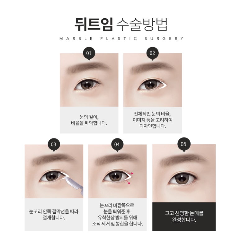 눈뒤트임이 고민이라면? 마블성형외과의원 관련 이미지 4
