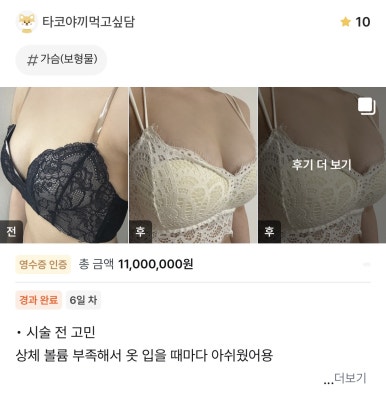 [강남성형외과 가슴확대수술 후기] 평생 고민이었던 짝가슴.. 원장님표 완벽한 대칭에 볼륨 대만족! 관련 이미지 1