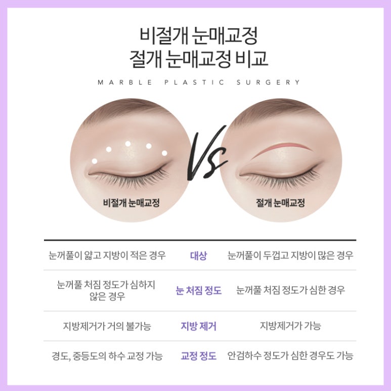 안검하수 처진눈 교정으로 또렷한 눈매를! 관련 이미지 10