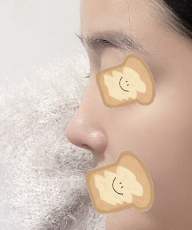 [Gangnam Station Plastic Surgery Nose Revision Review] A Tearful 4th Revision Marked by Failure... I Met Dr. Kim Jun-hyung and Succeeded! image 8