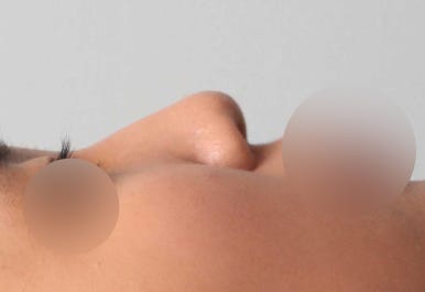 보형물 없이 하는 코수술, 무보형물 코수술이 가능한 경우는? 관련 이미지 5