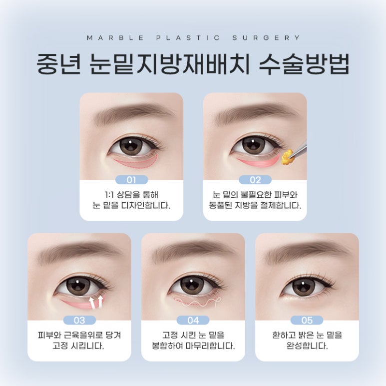 눈밑지방재배치비용 알아볼 때 중요한 것! 마블성형외과 관련 이미지 5