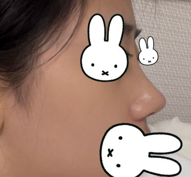 [강남성형외과 복코성형 후기] 두꺼운 피부라 얄쌍해지기 어렵다던 제 복코.. 지금은 콧볼까지 얇아졌어요 관련 이미지 5