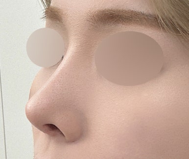 [Gangnam Plastic Surgery Clinic Hump Nose Surgery Review] Worried It Might Look Unnatural, I Hesitated About My Hump Nose… Adding Bulbous Nose Correction Helped Me Settle on My Perfect Nose Line! image 5