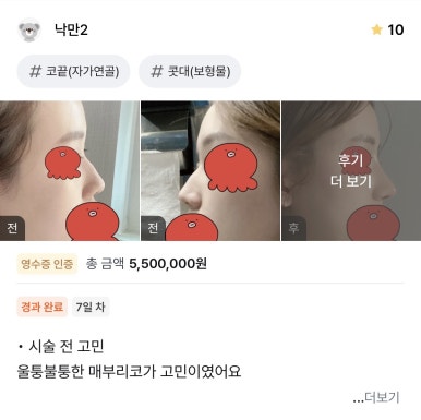 [강남성형외과 매부리코성형 후기] 부작용만 찾다가,, 금손 원장님 만나 코 정착했어요! 관련 이미지 1
