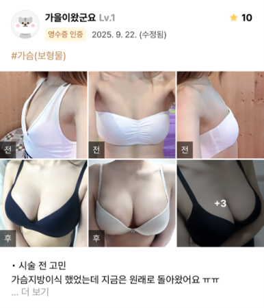 [마블성형외과 가슴수술 후기] 지방이식 후 빠져버린 가슴... 결국 보형물이 답이었네요ㅠㅠ 관련 이미지 1