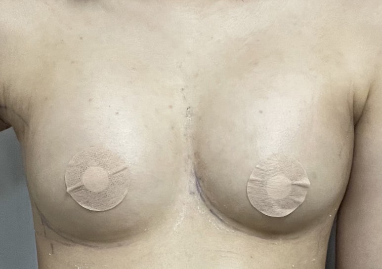 One-Month Real Review After Breast Augmentation ｜ From Right After Surgery to the Changes Over Time image 7