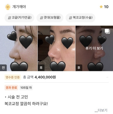 [Gangnam Plastic Surgery Rhinoplasty Review] I Was Worried About My Bulbous Nose.. It Turned Out Beautiful While Healing Well Without Inflammation or Side Effects hehe image 1