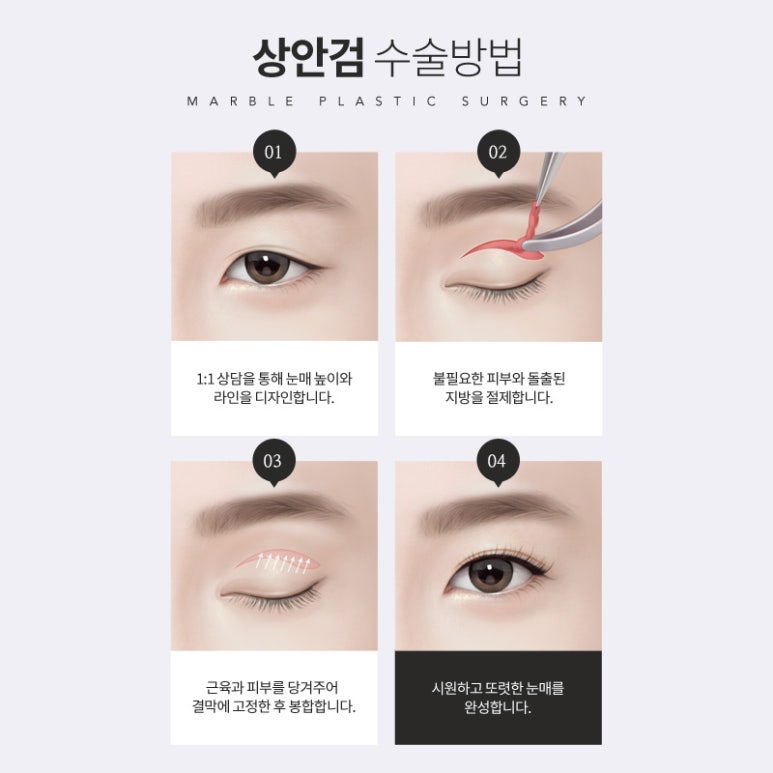중년눈성형 잘 알아보고 해야 하는 이유? 관련 이미지 4